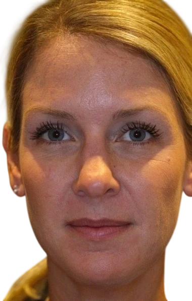 Brow Lift Knoxville result 4 After