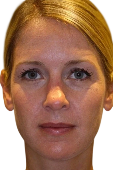 Brow Lift Knoxville result 4 Before