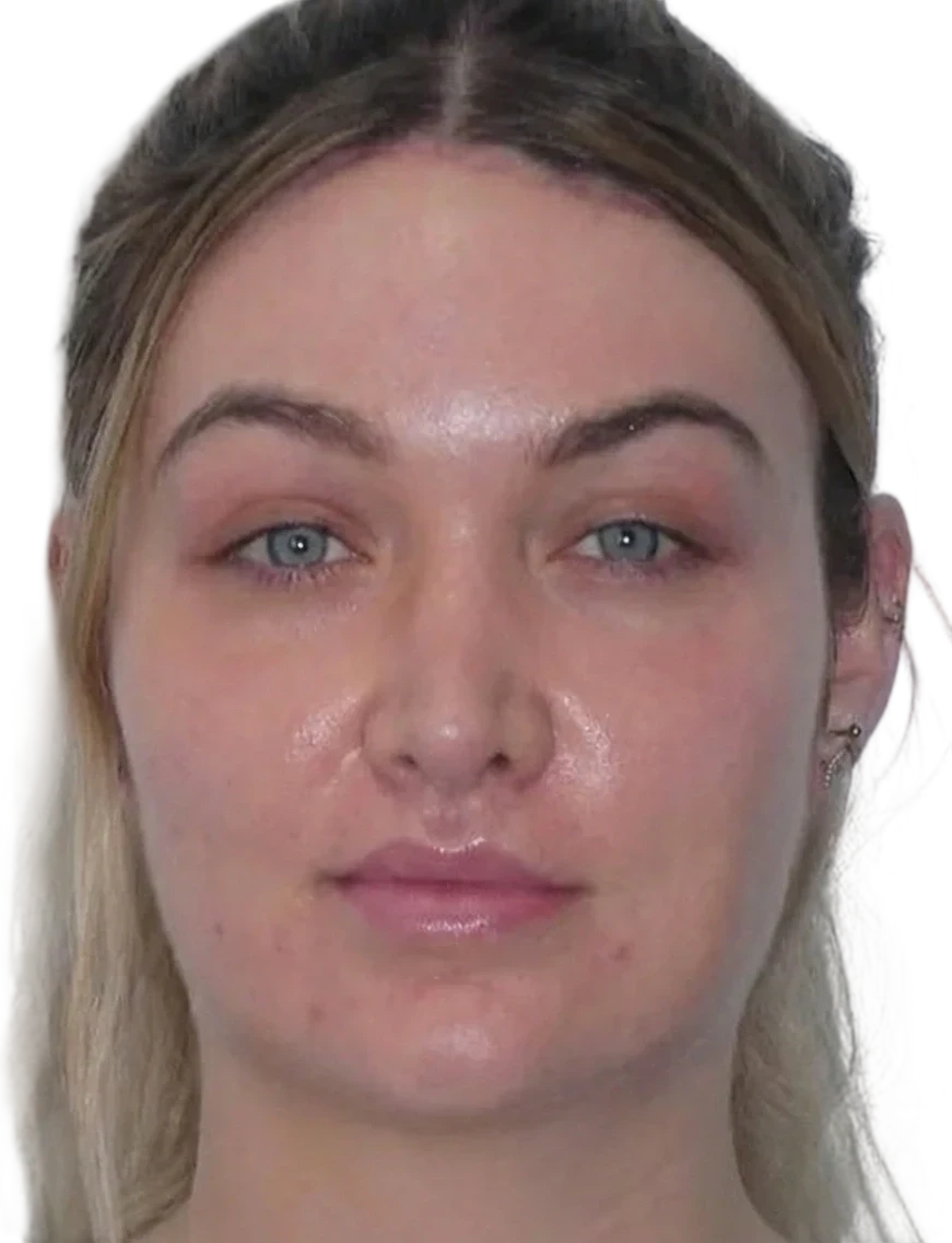 Brow Lift Knoxville result 5 After