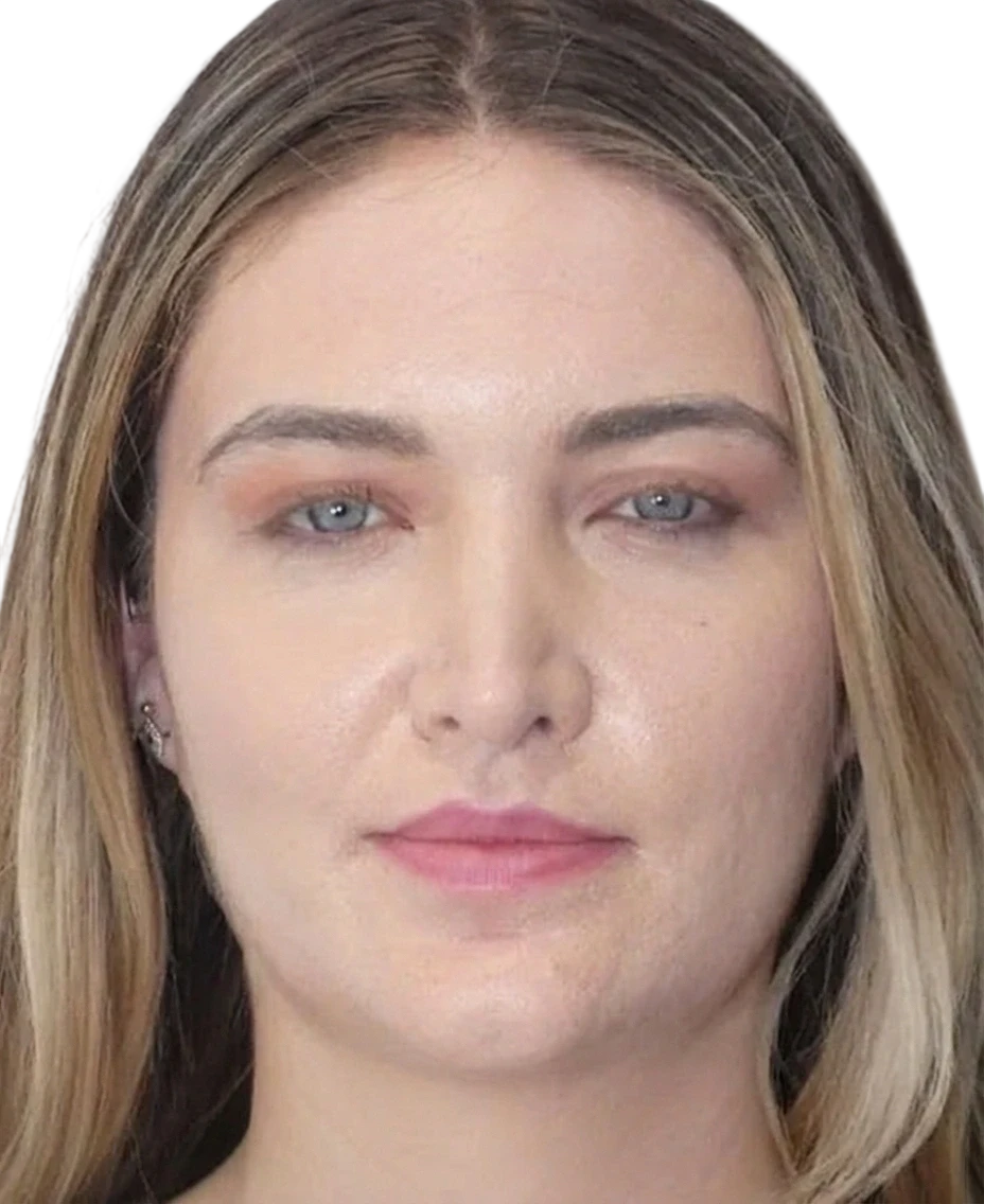 Brow Lift Knoxville result 5 Before