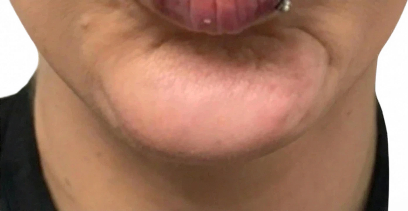 Chin Dimpling after
