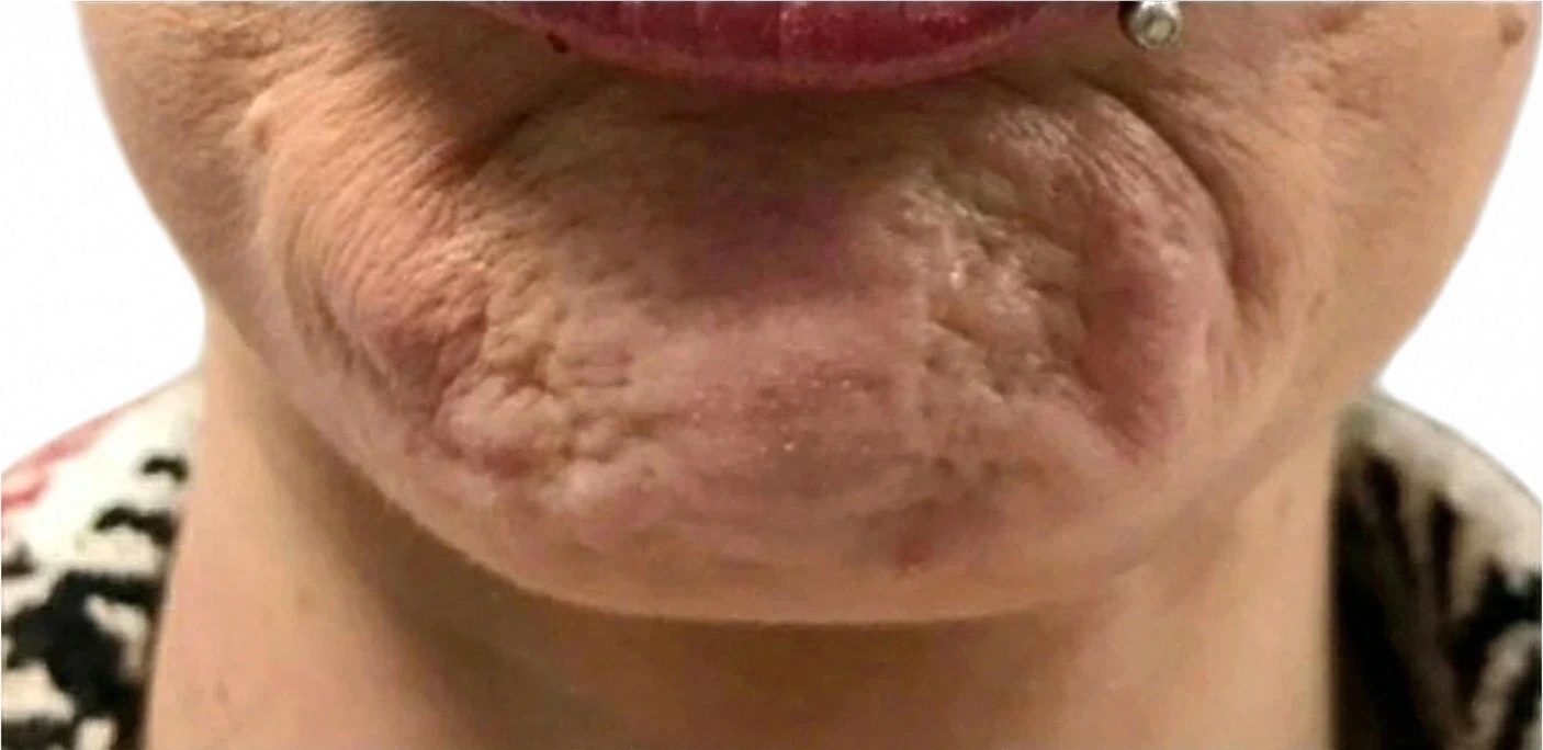 Chin Dimpling before