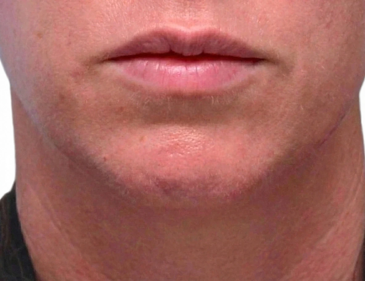 Chin Dimpling Knoxville result 2 Before