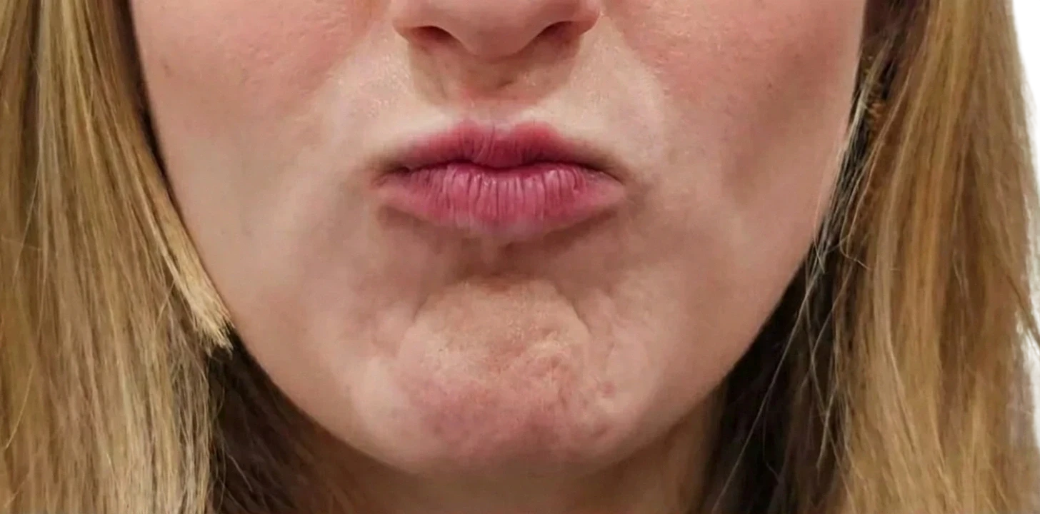 Chin Dimpling Knoxville result 3 Before