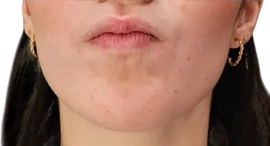 Chin Dimpling Knoxville result 4 After