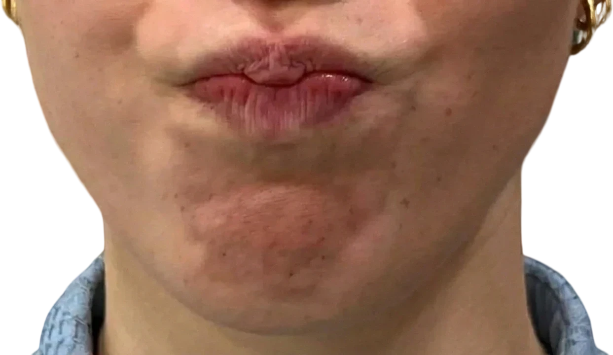 Chin Dimpling Knoxville result 4 Before