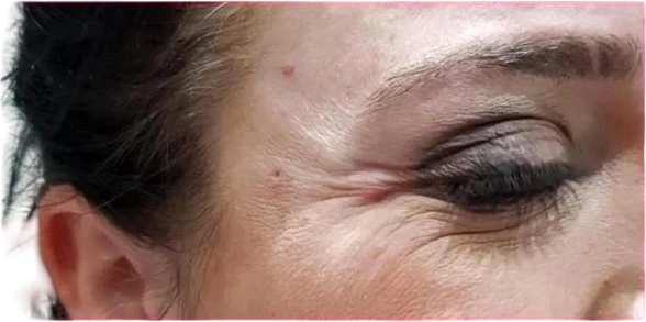 Crow's Feet Knoxville result 4 Before