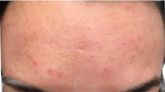 Forehead Lines Knoxville result 2 After