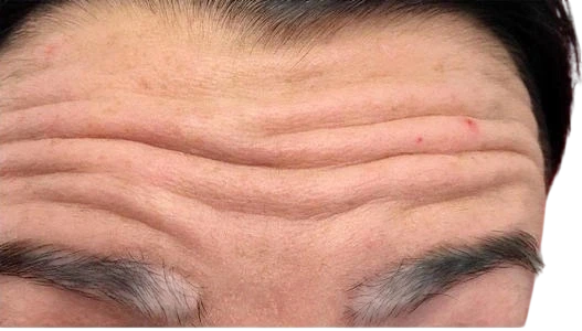 Forehead Lines Knoxville result 2 Before