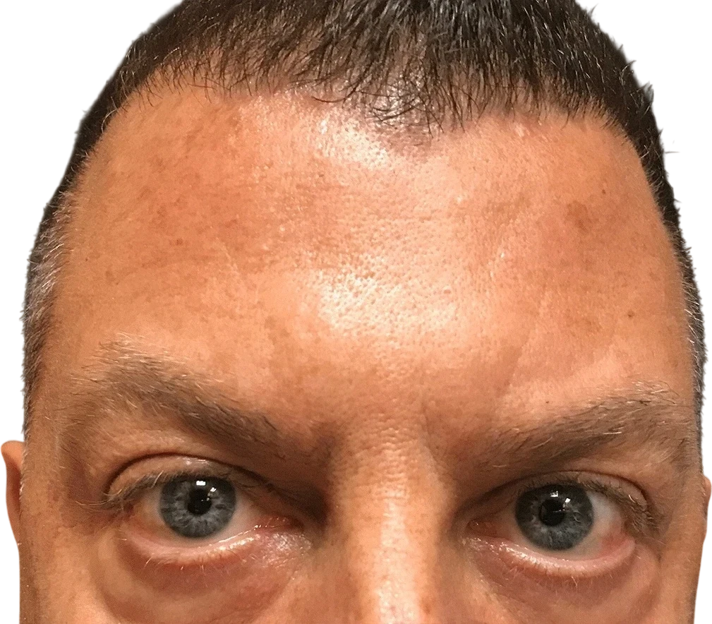 Forehead Lines Knoxville result 3 After