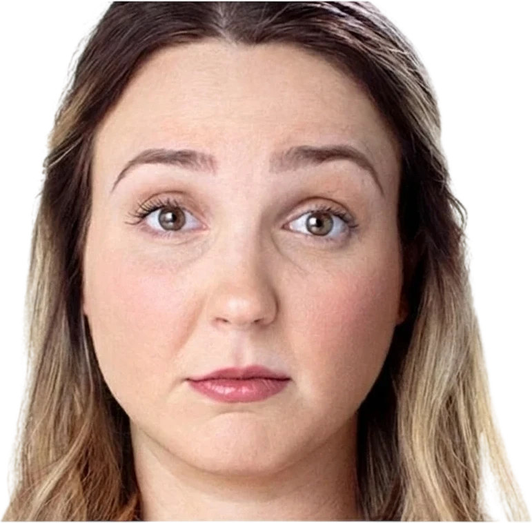 Forehead Lines Knoxville result 4 Before