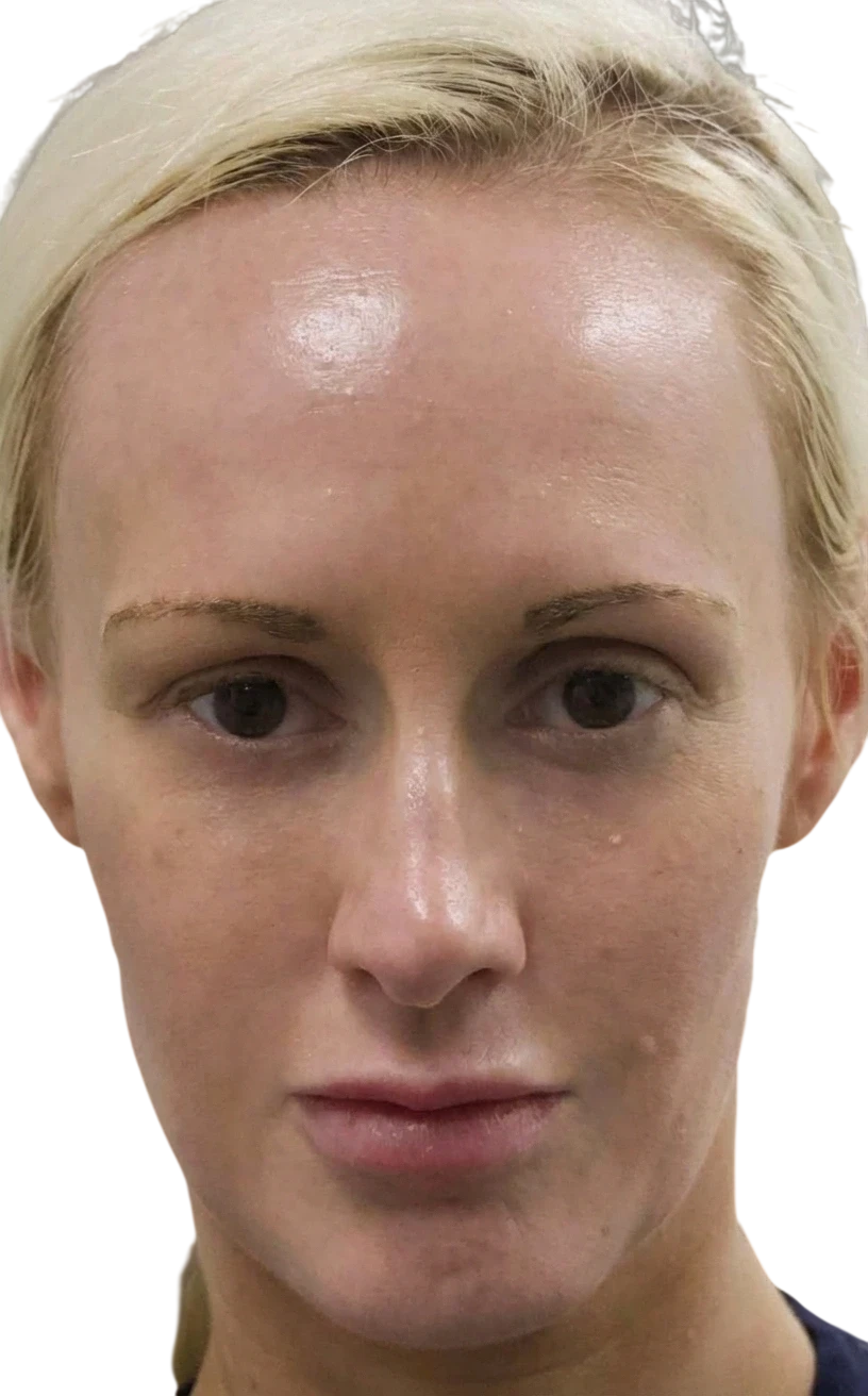 Forehead Lines Knoxville result 5 After