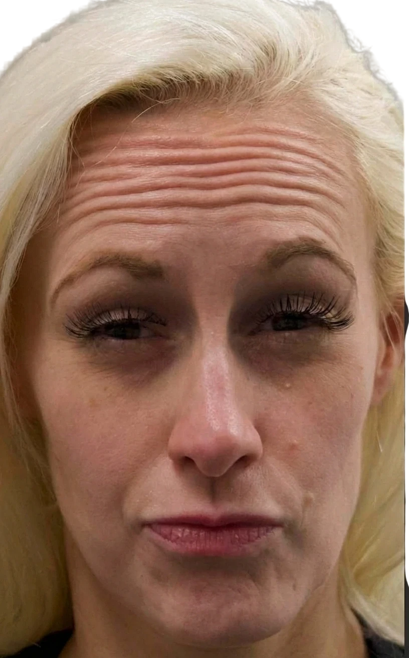 Forehead Lines Knoxville result 5 Before