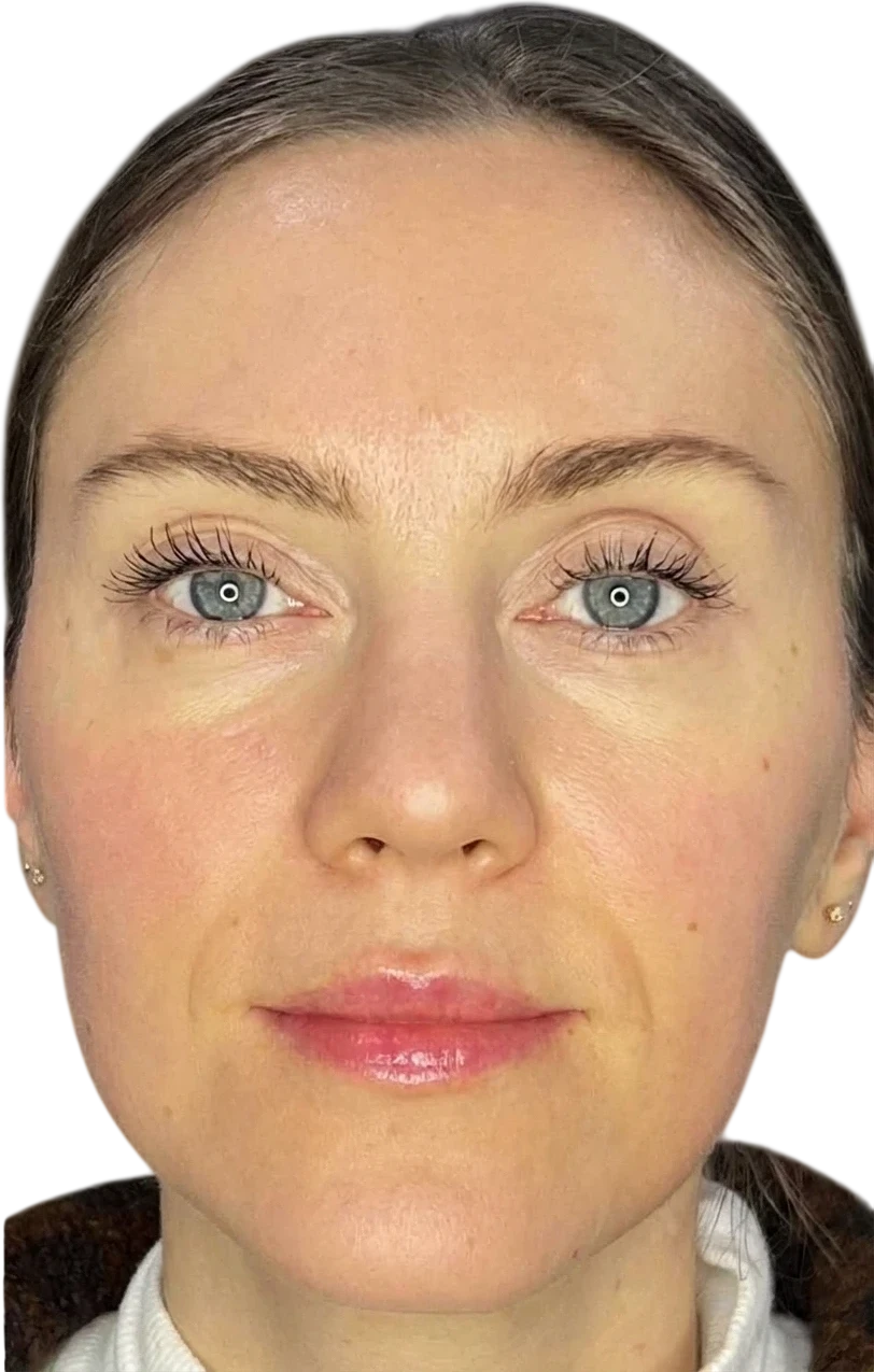 Forehead Lines Knoxville result 6 After