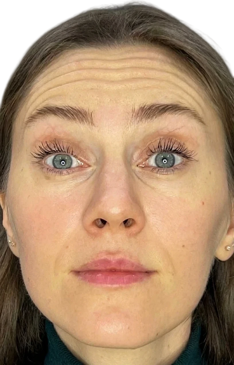 Forehead Lines Knoxville result 6 Before