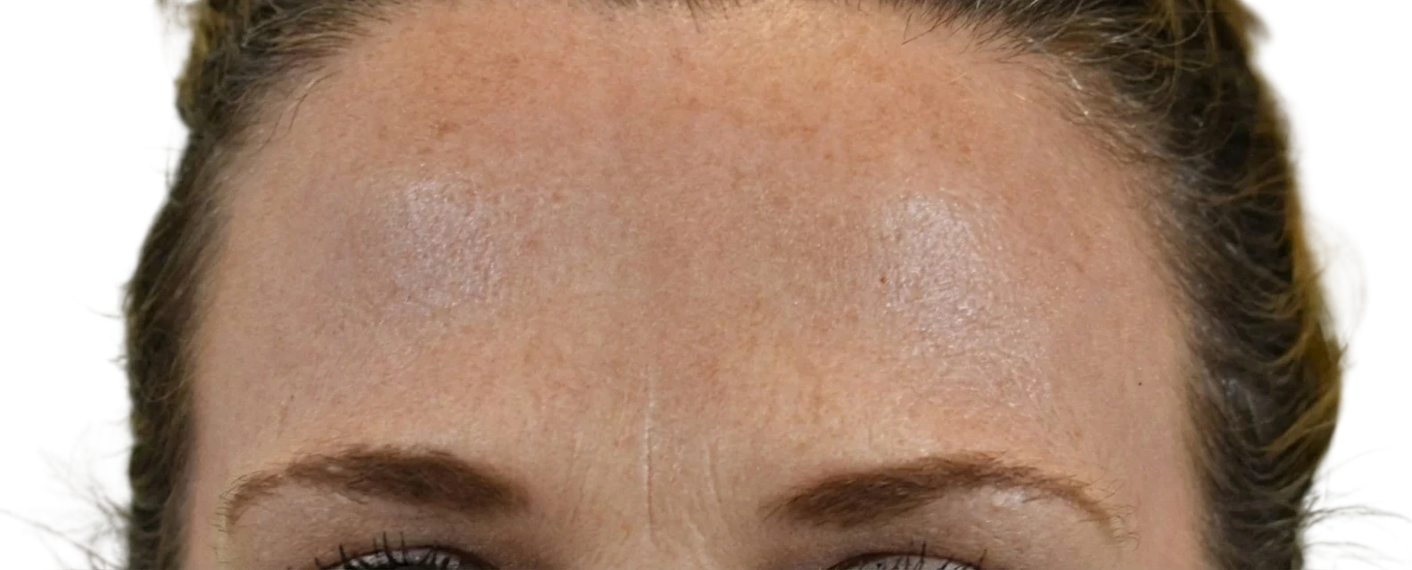 Forehead Lines Knoxville result 7 After