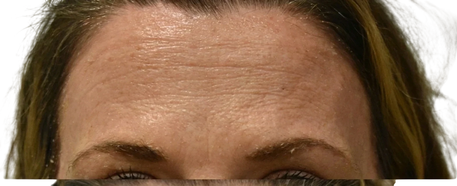 Forehead Lines Knoxville result 7 Before