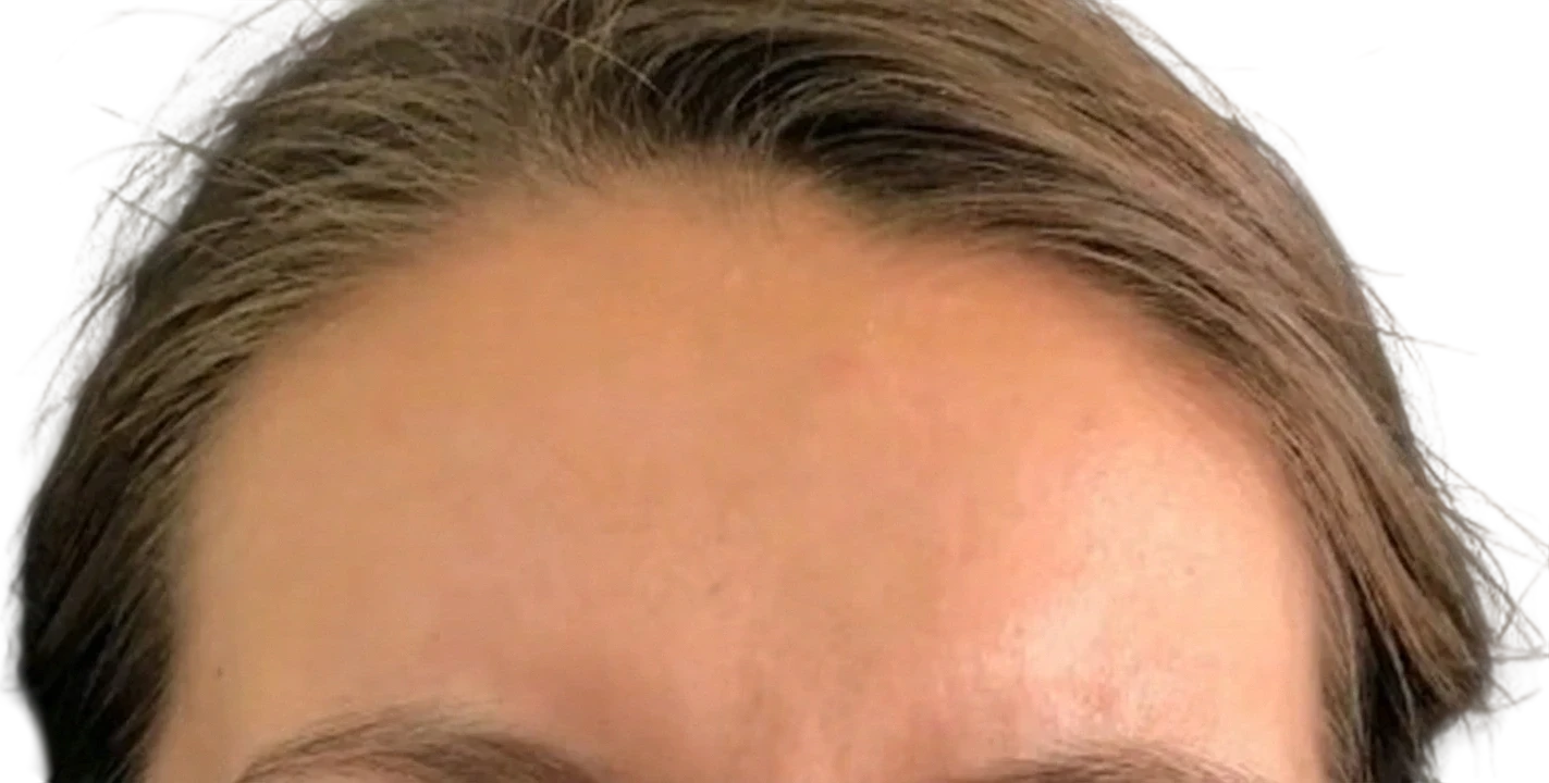 Frown Lines Knoxville result 4 After