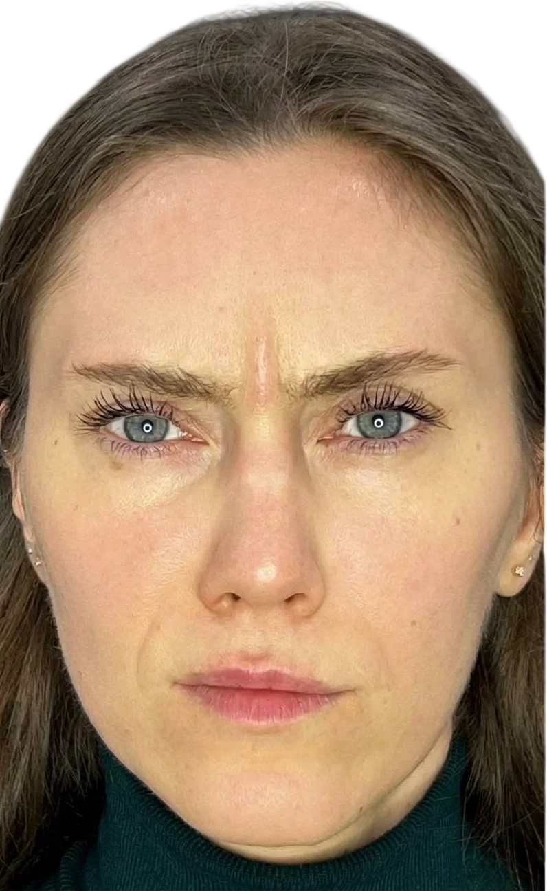 Frown Lines Knoxville result 5 Before