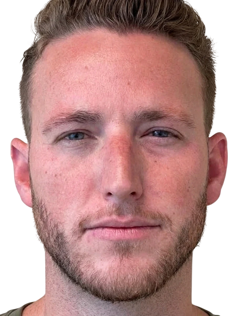 Frown Lines Knoxville result 6 After