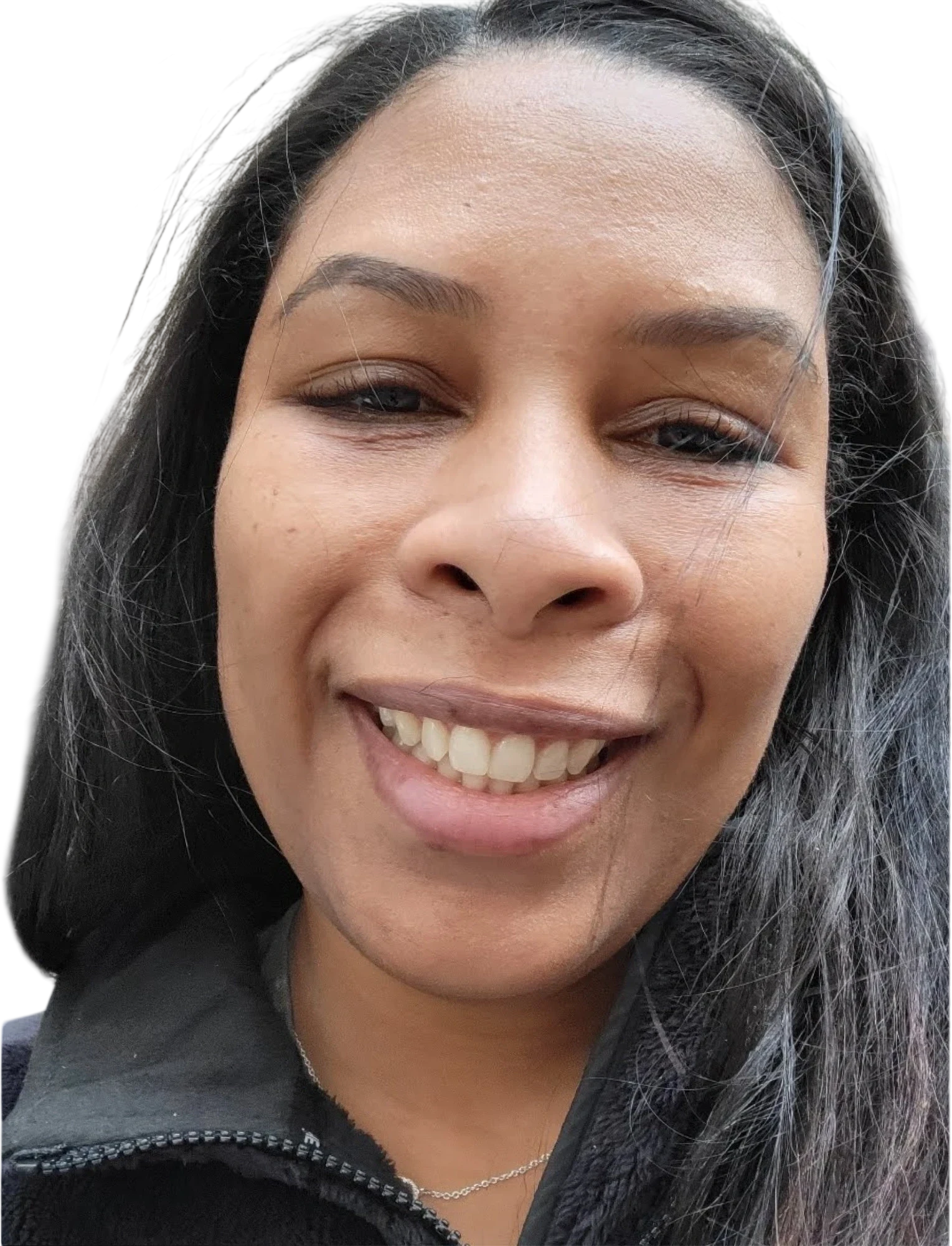 Gummy Smile Knoxville result 2 After