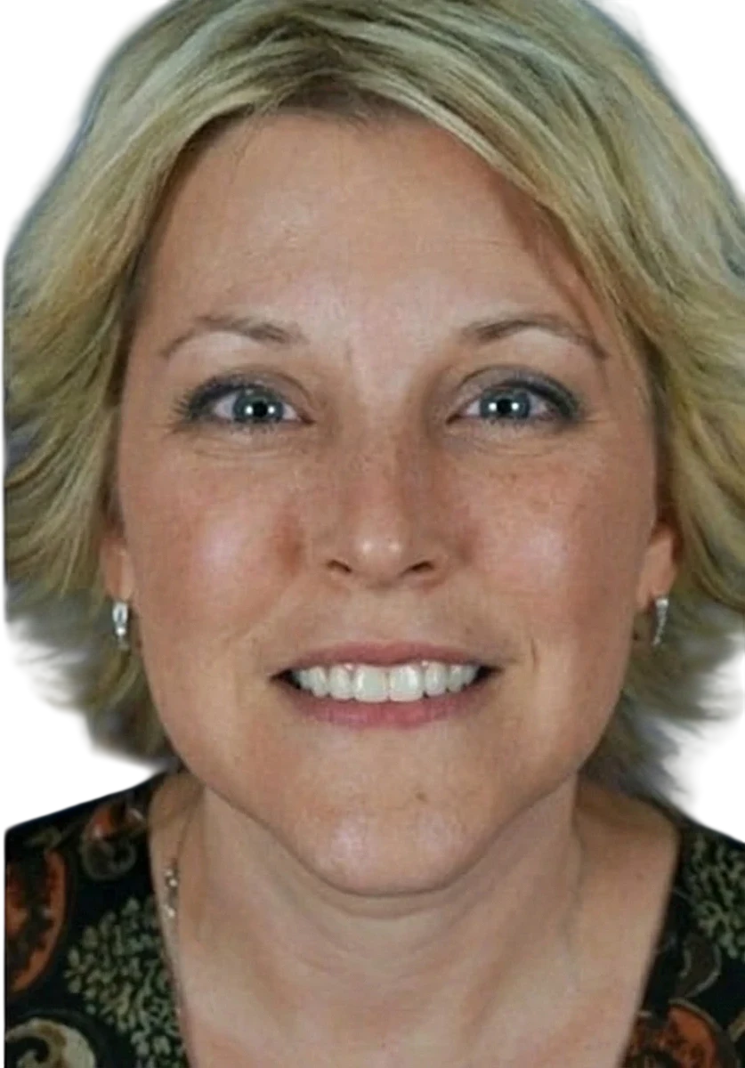 Gummy Smile Knoxville result 3 After