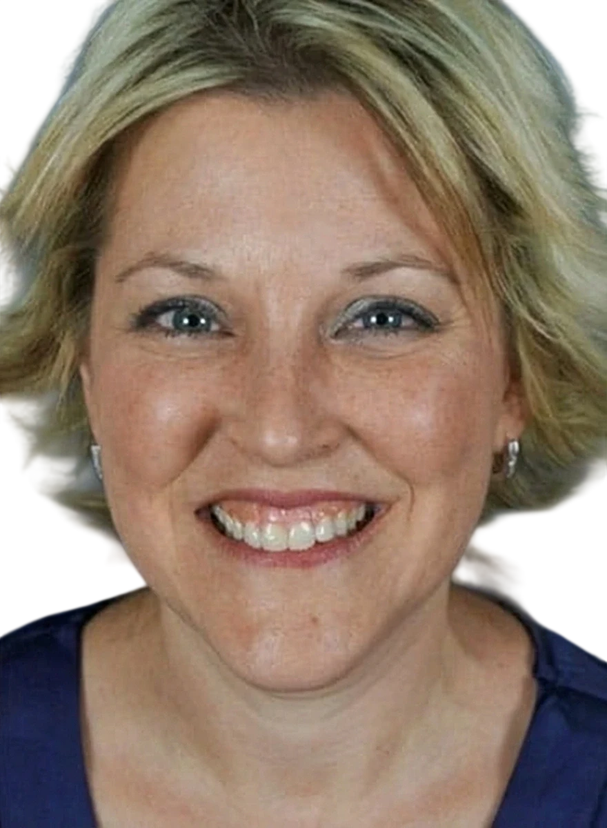 Gummy Smile Knoxville result 3 Before