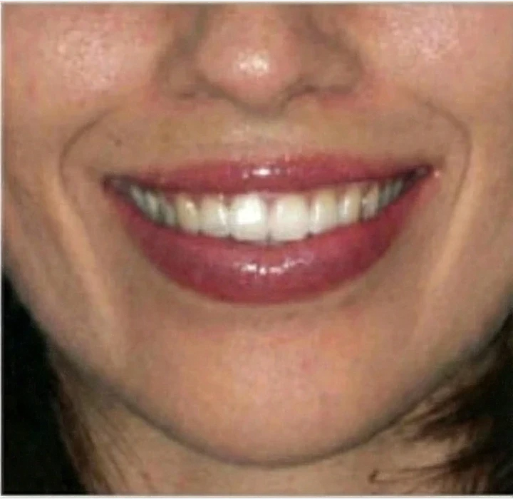 Gummy Smile Knoxville result 4 After