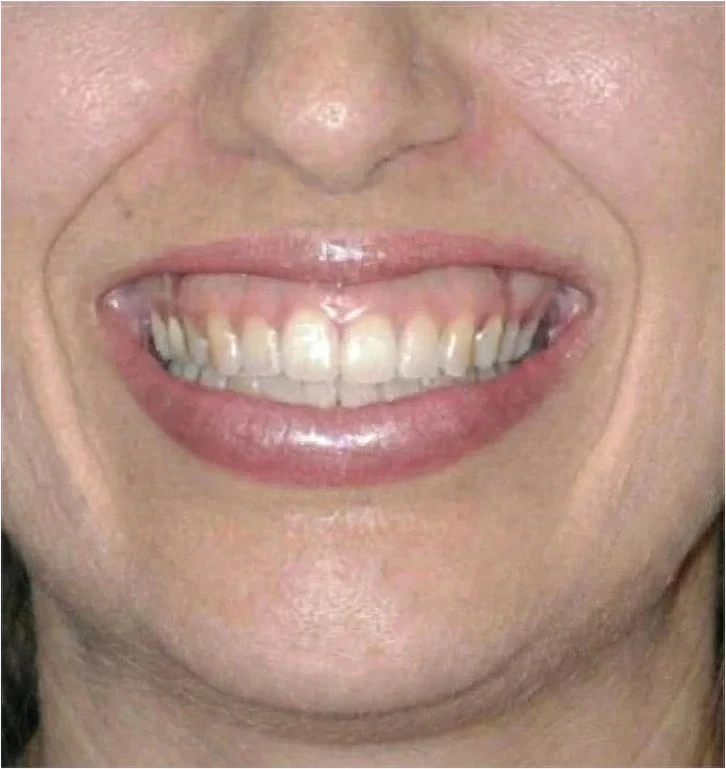 Gummy Smile Knoxville result 5 Before