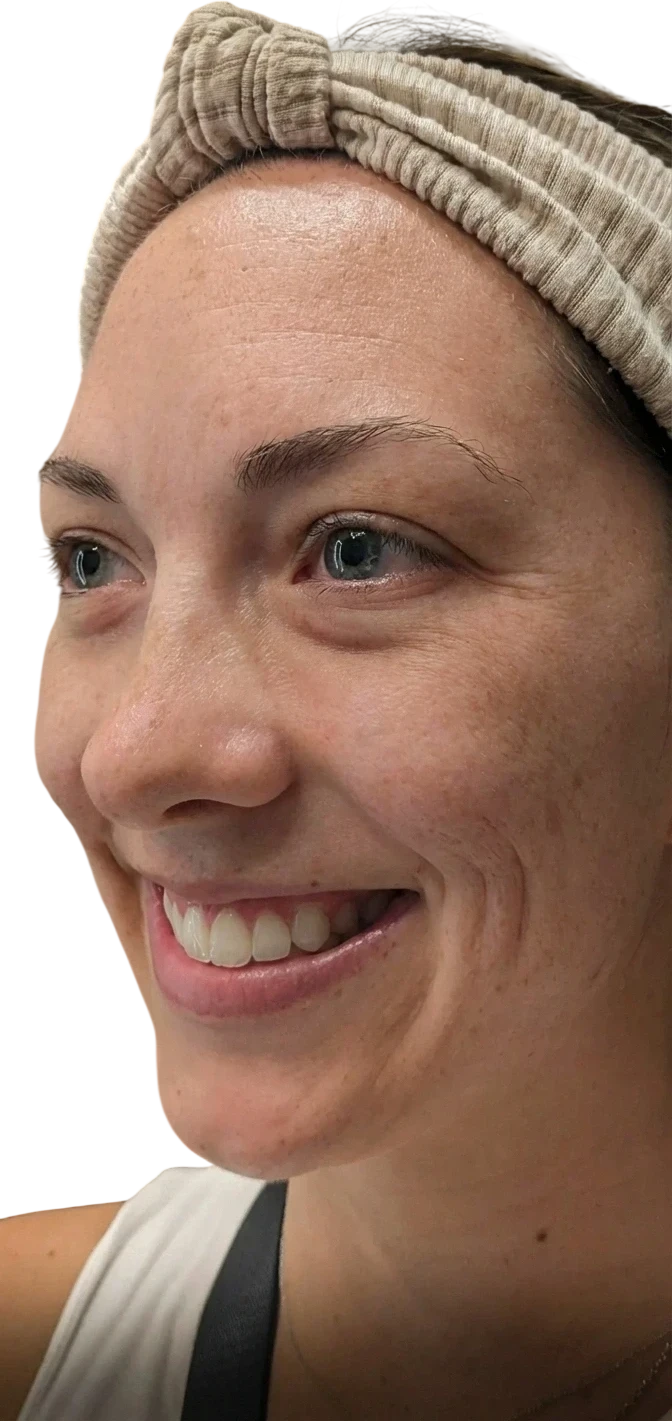 Gummy Smile Knoxville result 6 Before