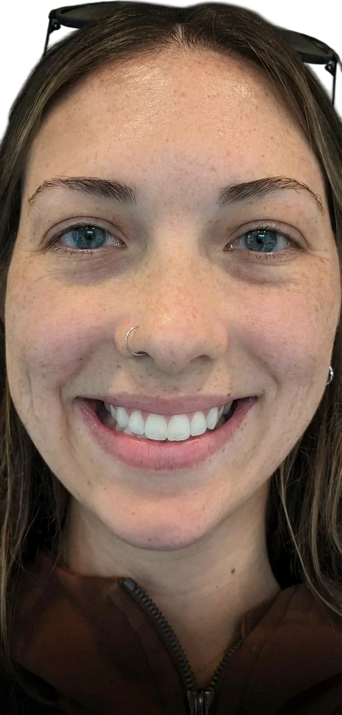 Gummy Smile Knoxville result 7 After