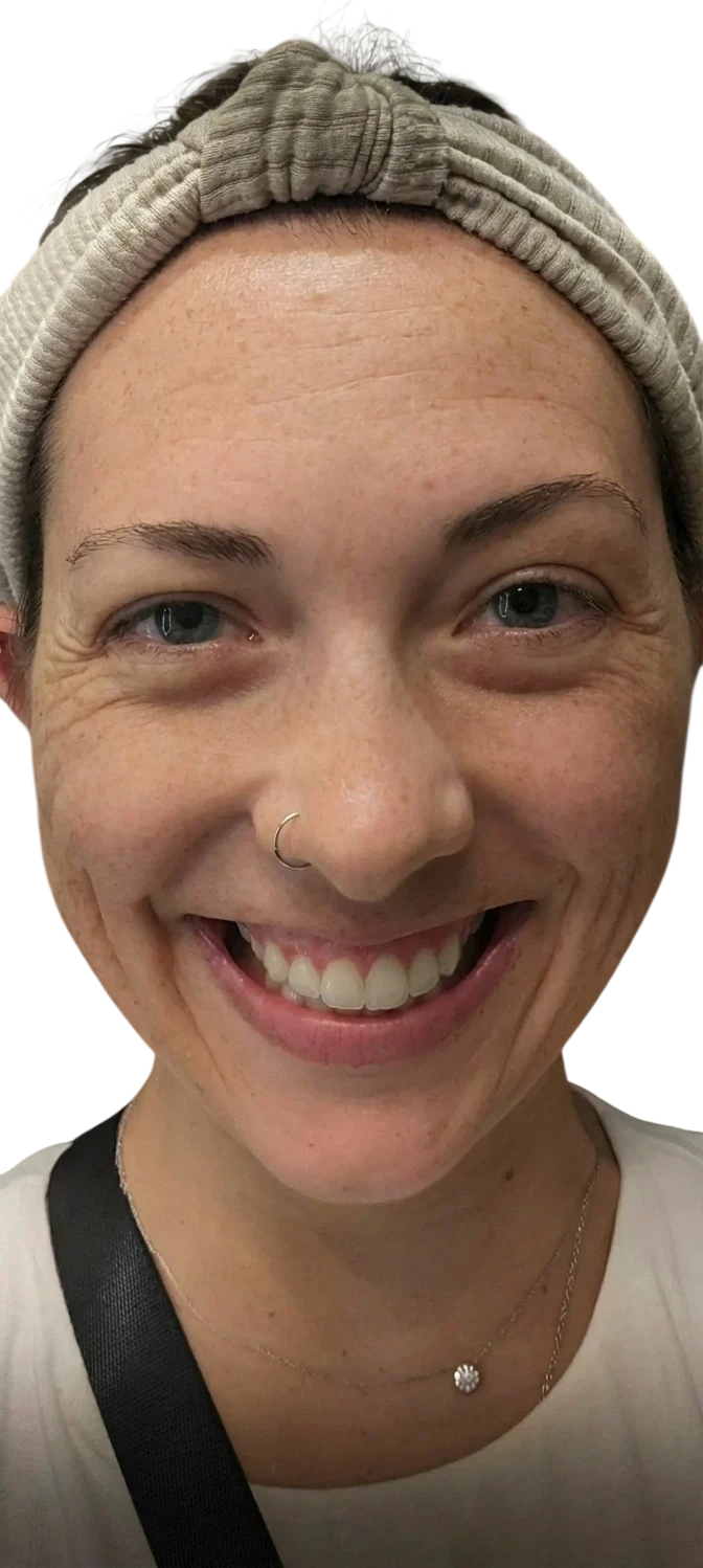 Gummy Smile Knoxville result 7 Before