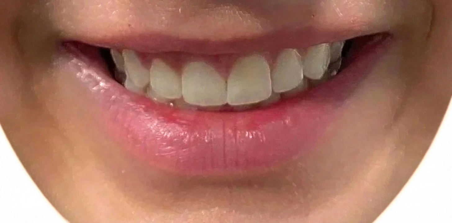 Lip Flip Knoxville result 5 Before