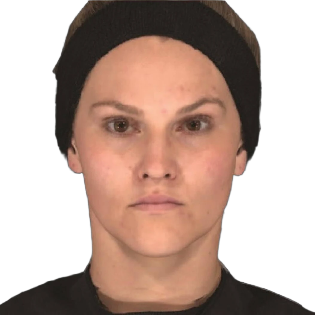 Masseter Botox Knoxville result 1 After