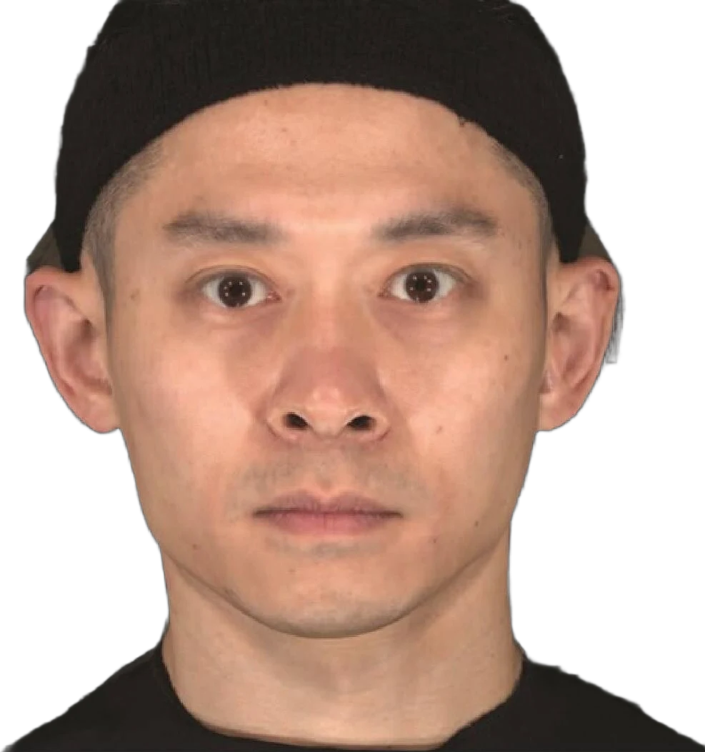 Masseter Botox Knoxville result 2 After
