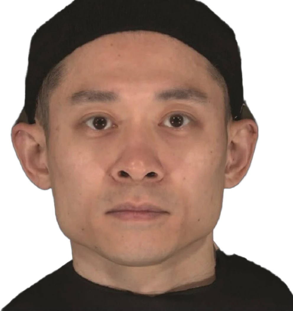 Masseter Botox Knoxville result 2 Before