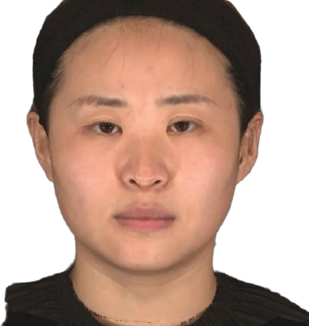 Masseter Botox Knoxville result 3 After