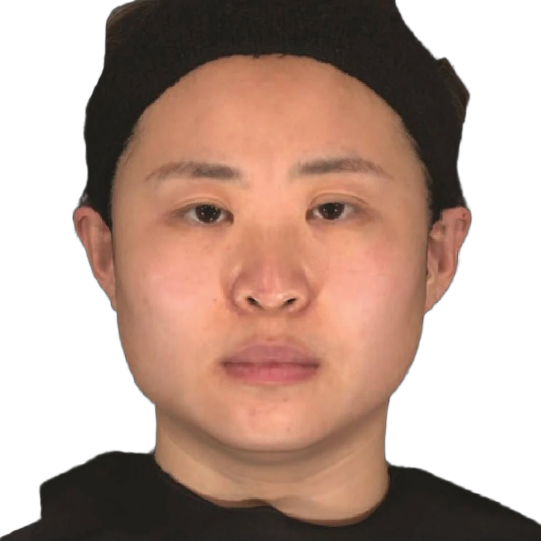 Masseter Botox Knoxville result 3 Before