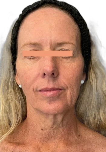 Everesse Face