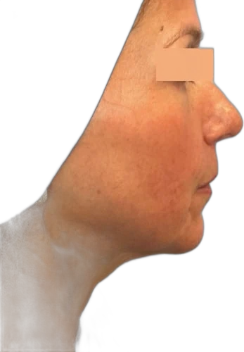 Everesse Jawline