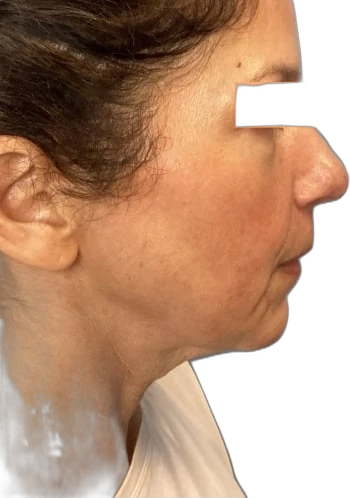 Everesse Jawline before