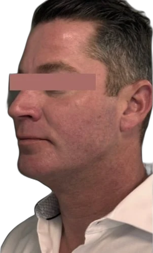 Everesse Jawline Knoxville result 3 After