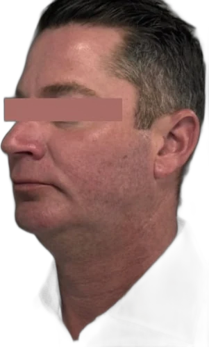 Everesse Jawline Knoxville result 3 Before