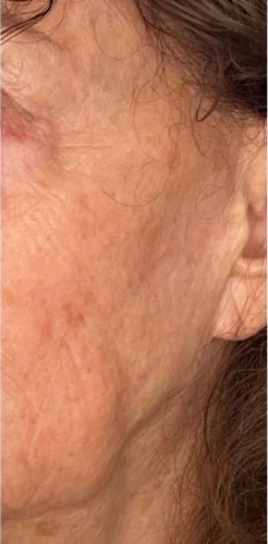 Everesse Neck