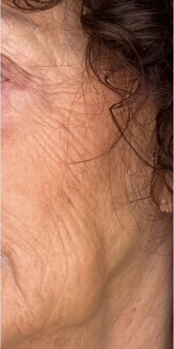 Treatment result 1 before