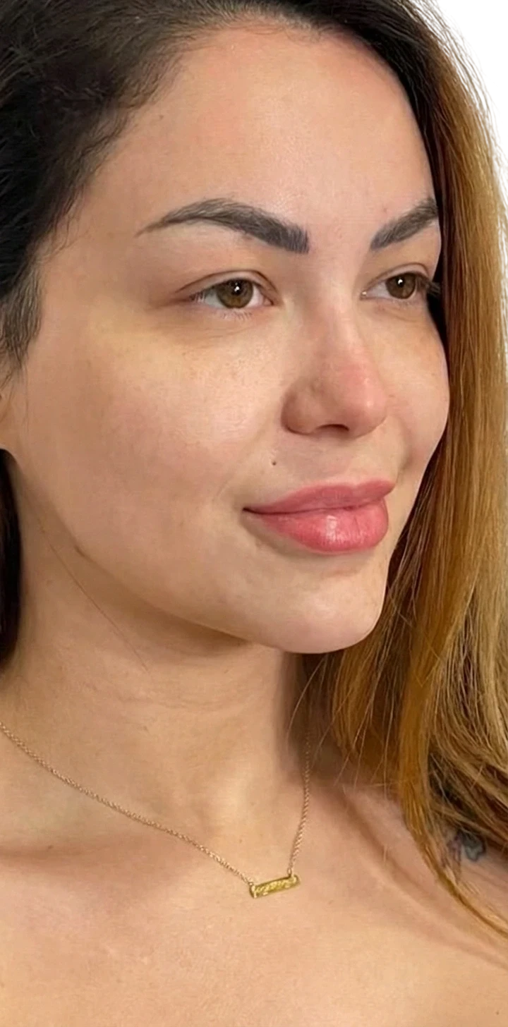 Nasolabial Folds Knoxville result 2 Before