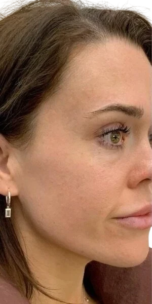 Nasolabial Folds Knoxville result 3 Before