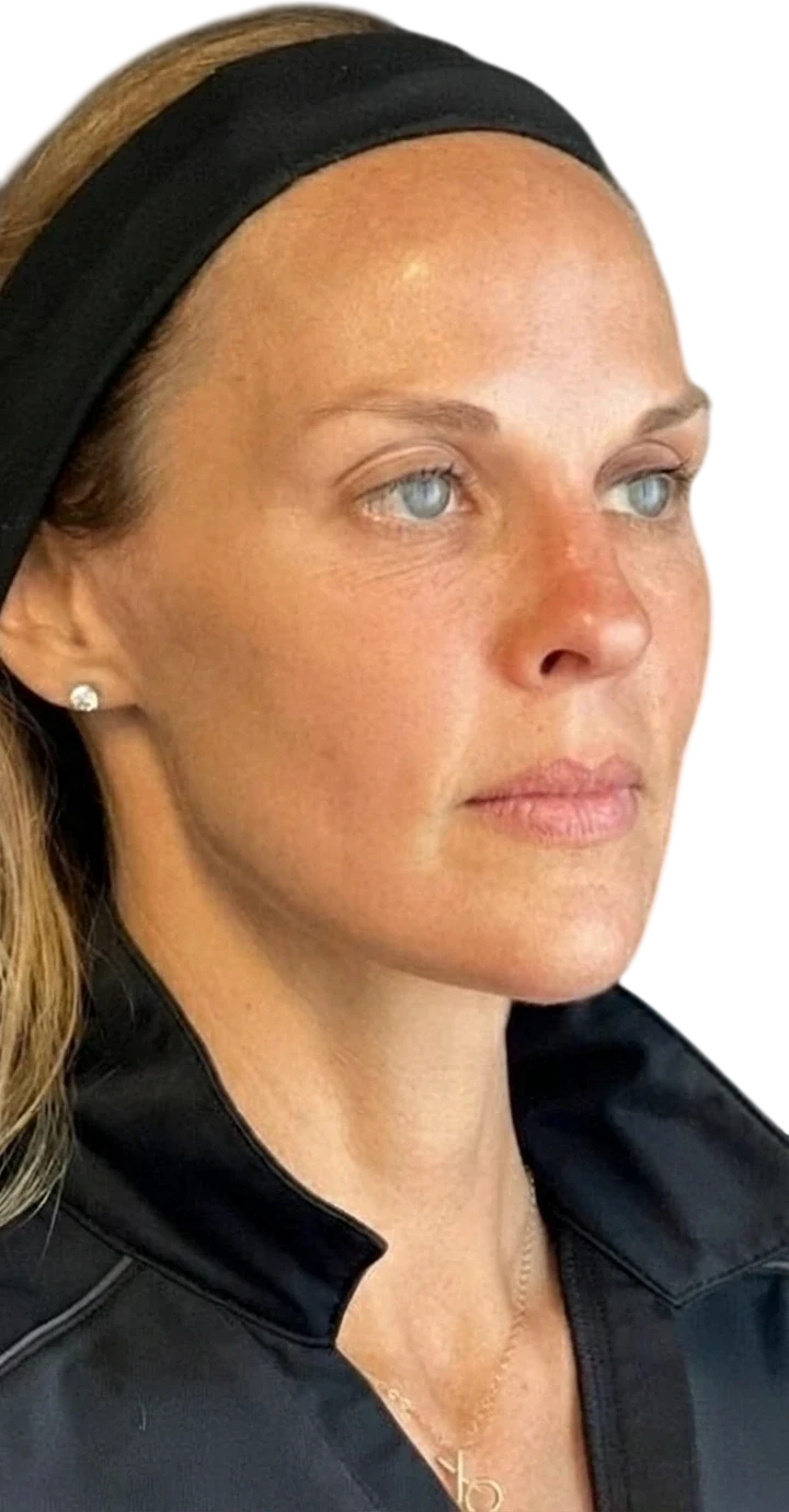 Nasolabial Folds Knoxville result 4 After