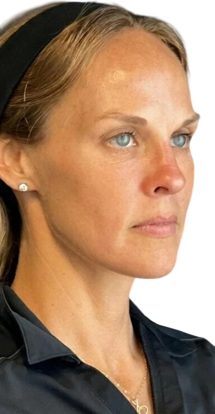 Nasolabial Folds Knoxville result 4 Before