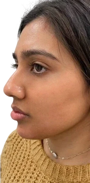 Nasolabial Folds Knoxville result 5 After